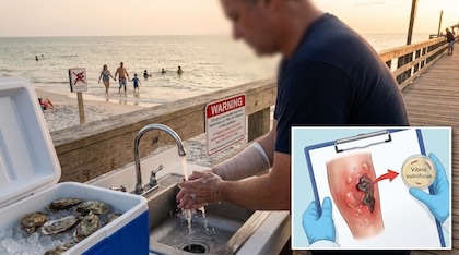 Cuáles son las señales de Vibrio vulnificus, la peligrosa bacteria “come carne”